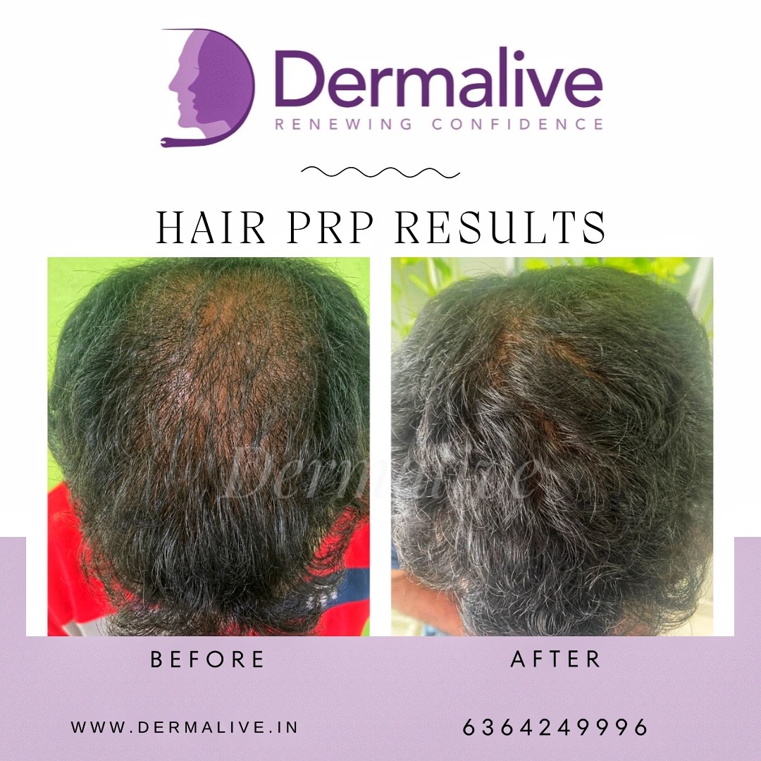 Before After Progress