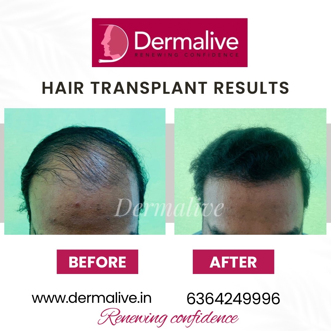 Before After Treatment