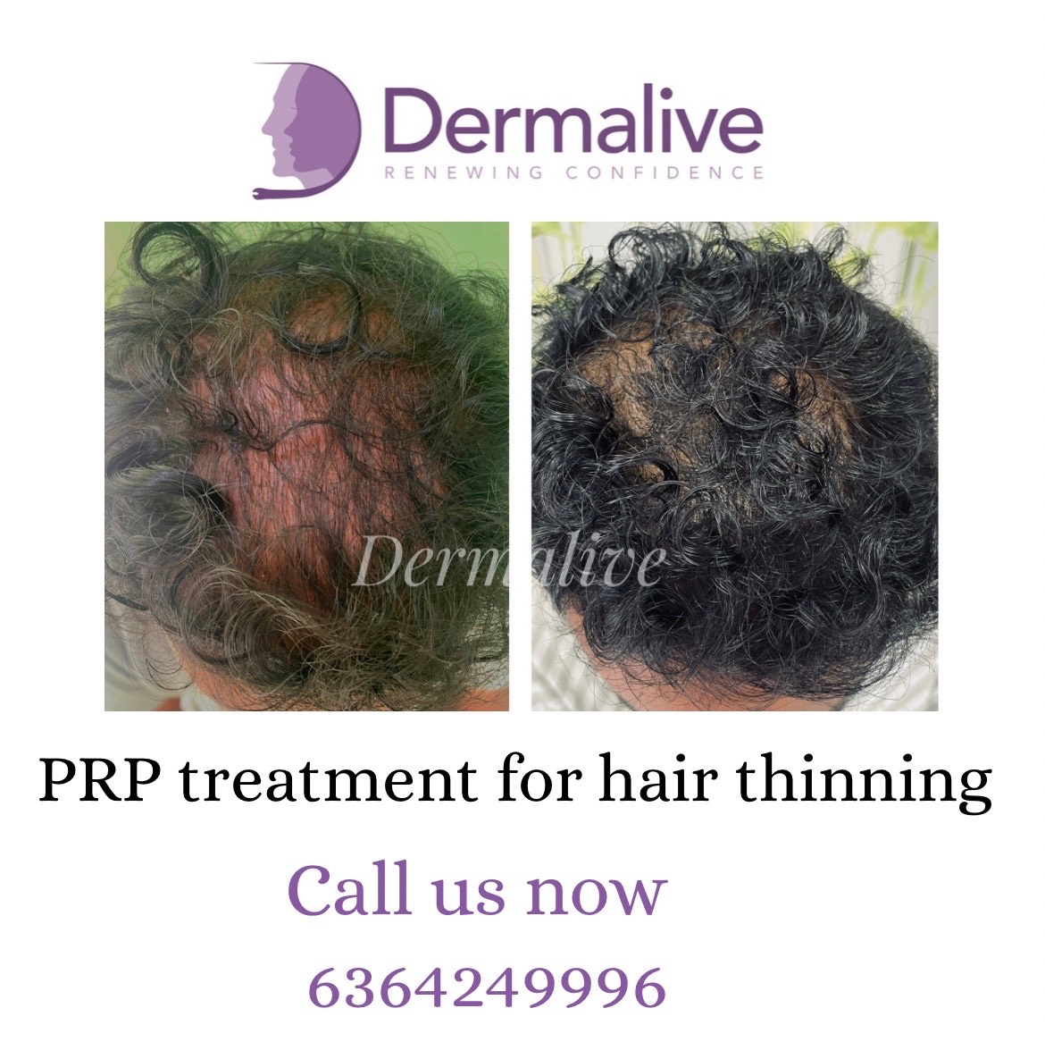 Hair Transplant 2500 Grafts