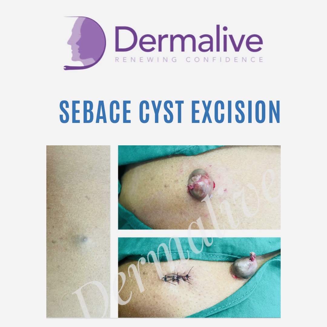 Sebace Cyst Excision